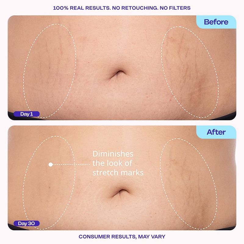 Tighten & Smooth Belly Cream, MicroTight4 Complex Body Firming Lotion for Loose Skin💜💜